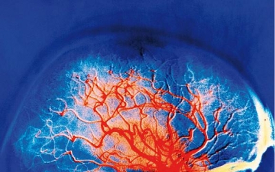 Գիտնականները կապ են գտել ալերգիայի ու ուղեղի քաղցկեղի միջեւ. news.am