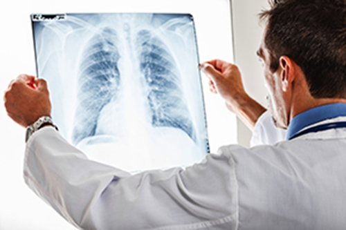 Թոքի ոչ մանր բջջային քաղցկեղ. ռիսկի գործոնները և կանխարգելումը. oncology.am