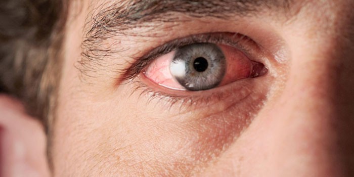 Почему при курении марихуаны краснеют глаза есть ли тесты на соль наркотик