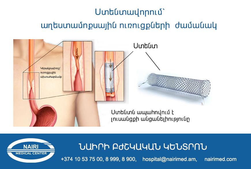 Ստենտավորում` աղեստամոքսային ստրոմալ ուռուցքների ժամանակ. nairimed.com