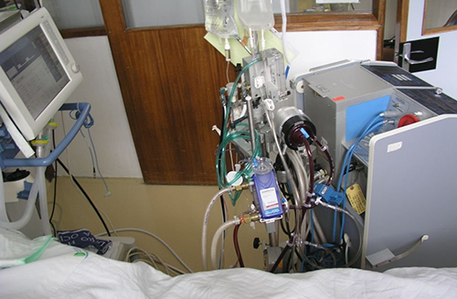 Экстракорпоральная оксигенация спасла жизни многих пациентов с ковидом