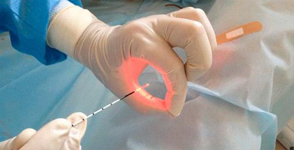 В России создана новая технология проведения операций методом лазерной хирургии