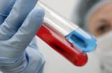 Американские врачи объявили о втором случае излечения от ВИЧ-инфекции