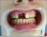 Реплантация зуба: medlux.am