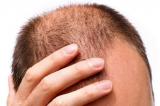 Исследователи объяснили, почему при стрессе уменьшается объем волос на голове