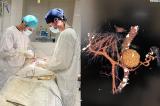 ԵՊԲՀ. Համալսարանական վիրաբույժները փայծախային զարկերակի անևրիզմայի հազվադեպ հանդիպող վիրահատություն են կատարել