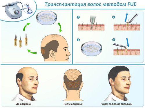 Մազերի փոխպատվաստում Դա Վինչի կլինիկայում